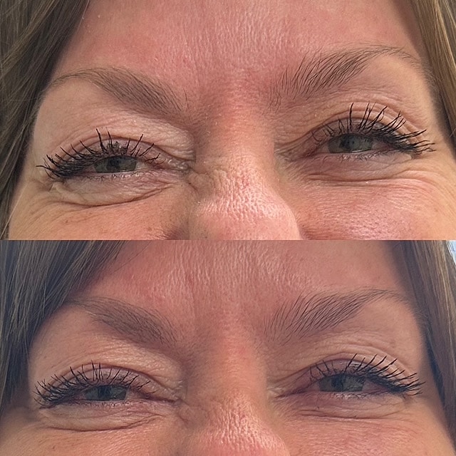 Neurotoxin Before & After